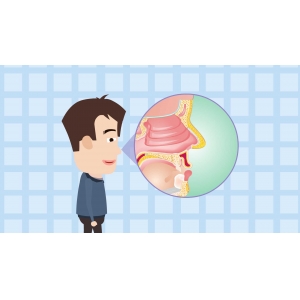 鼻息肉,鼻腔内的“不速之客”