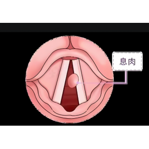 声音嘶哑、嗓子难受，声带息肉不可小觑