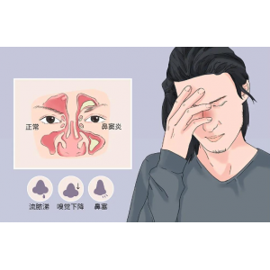 为什么感冒容易导致鼻窦炎，鼻窦炎该如何预防？