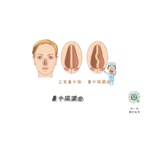 鼻塞、流涕、打喷嚏，是鼻炎引起的？注意可能是鼻中隔偏曲！