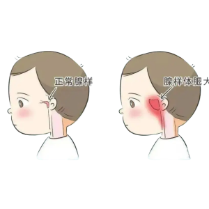 腺样体手术风险大吗？麻醉会影响孩子智商吗？