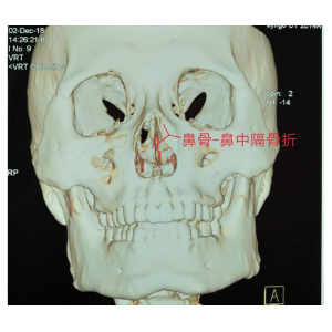 贵阳铭仁耳鼻喉医院提醒您：鼻子很脆弱，要好好保护