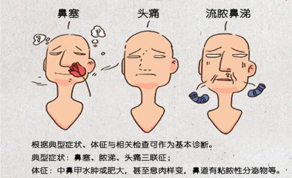 鼻炎的典型症状