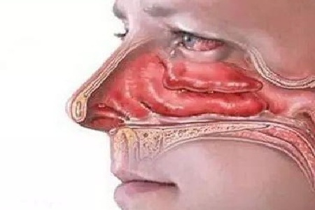 (贵阳治疗鼻息肉医院专科)贵阳首大眼鼻喉医院好不好(图2)