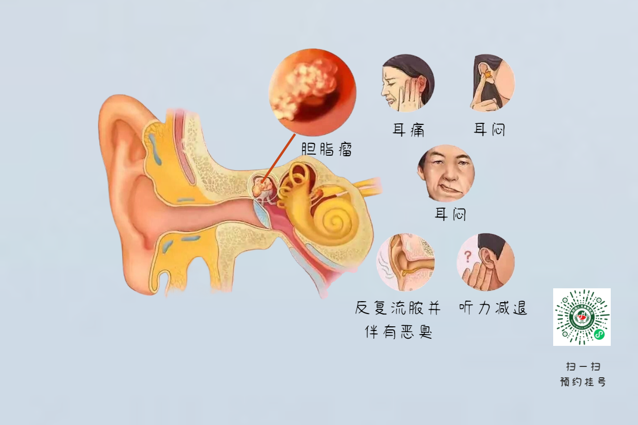 手术没做干净，术后3年颅内竟发现巨大胆脂瘤！(图6)