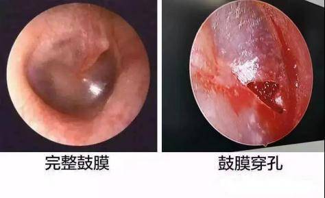中耳胆脂瘤：隐藏在耳内的“隐形杀手”(图2)