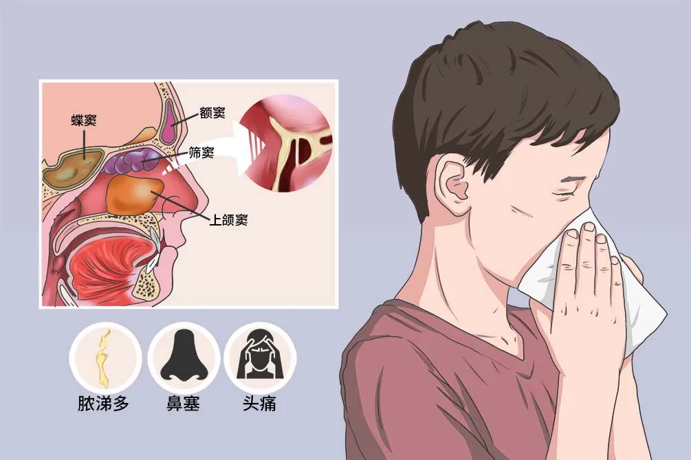 铭仁专家分享：治疗鼻窦炎的三个关键方法(图1)