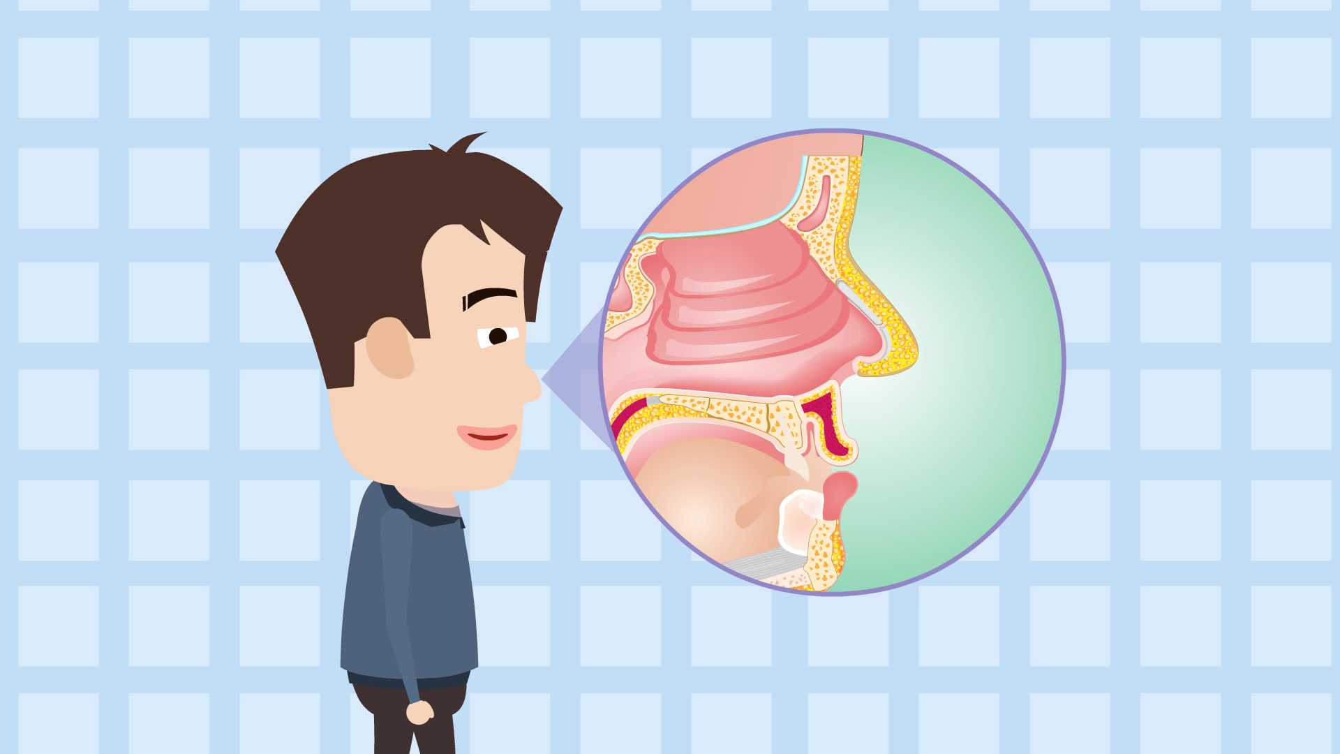 鼻息肉,鼻腔内的“不速之客”(图1)