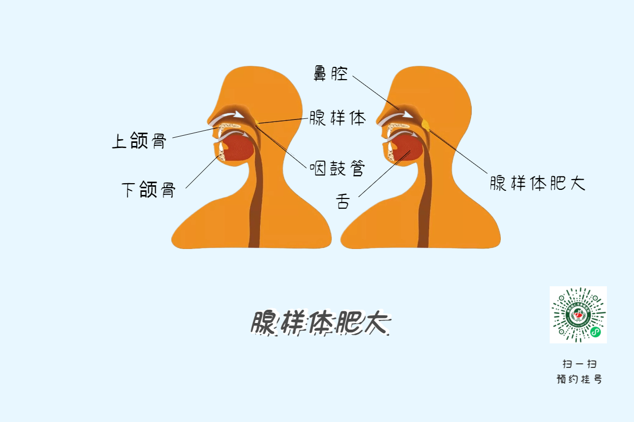 暑假来了，孩子腺样体肥大到底切不切？(图4)