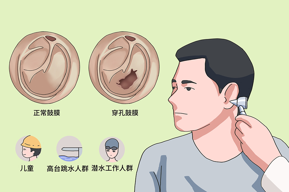 鼓膜穿孔不及时治疗，会导致听力下降，甚至引发颅内感染？(图3)