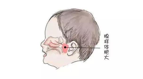 专家分享：父母注意！孩子腺样体肥大如果忽略，后果很严重！(图1)