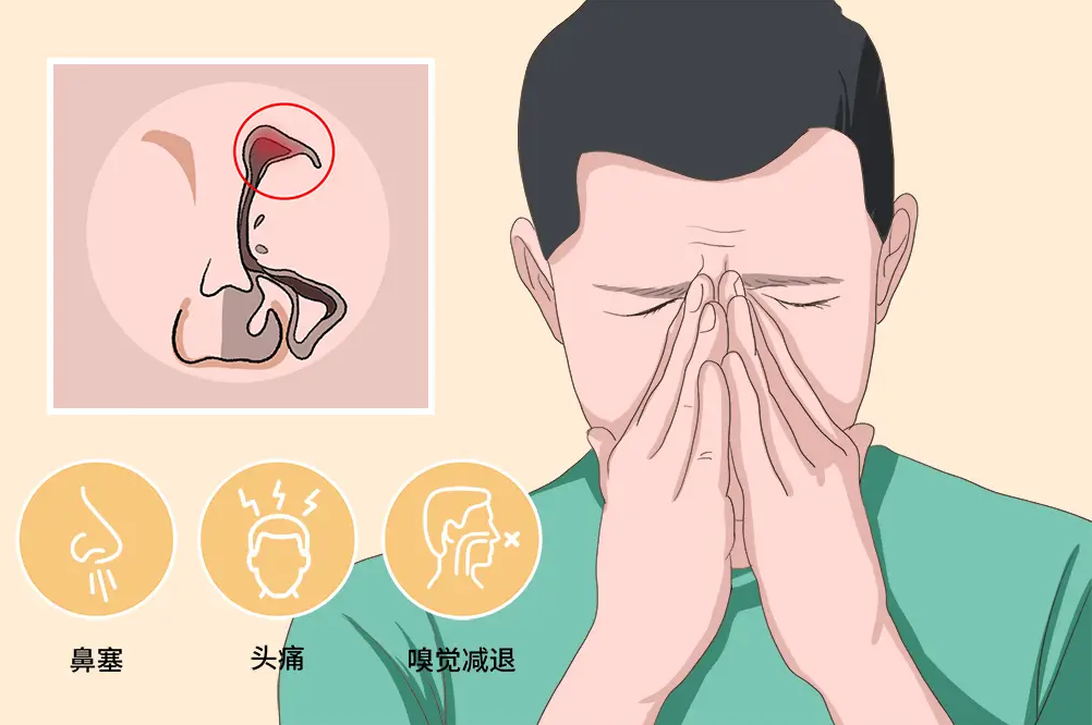 警惕：鼻窦炎多半竟是由感冒引起，如何远离鼻窦炎？(图2)