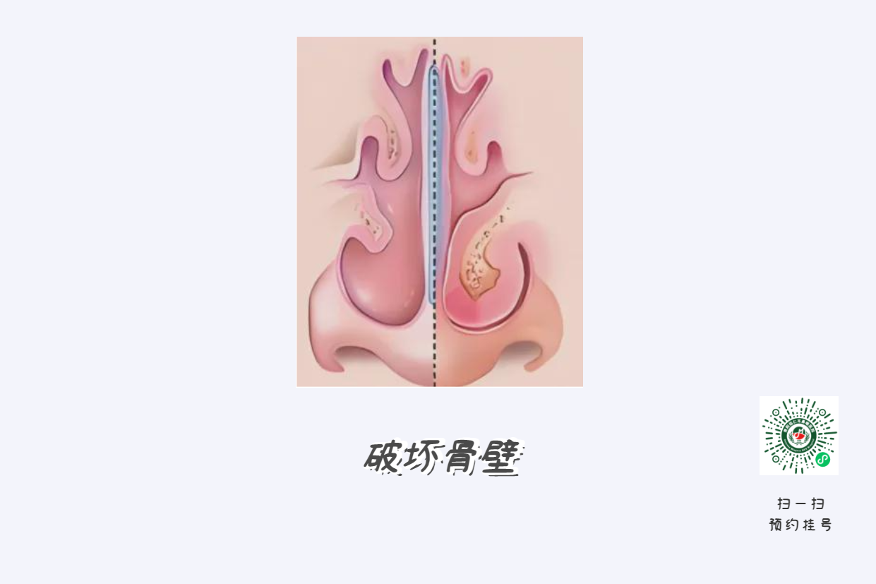 患上鼻窦炎不可小觑，当心五大并发症！(图2)