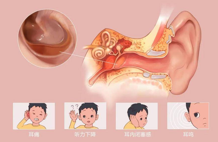 专家提醒小炎症大危害，别让外耳道炎毁掉你的听力！(图2)
