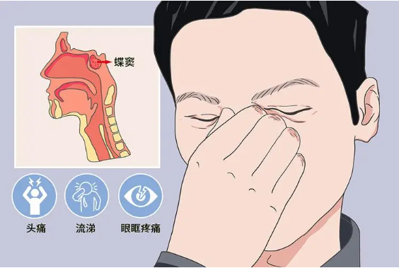 头疼、眼痛虽小，却可能是蝶窦炎发出的警告信号！(图1)