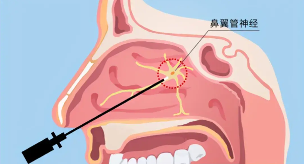 头疼、眼痛虽小，却可能是蝶窦炎发出的警告信号！(图2)