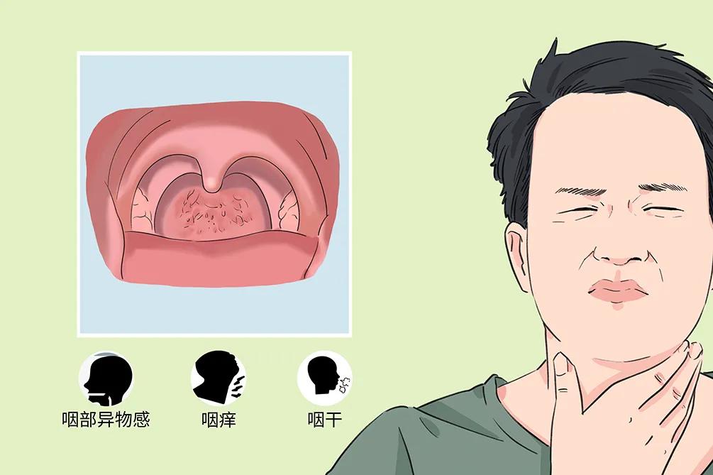 孩子咽干、喉部有异物感，警惕可能是慢性咽炎惹的祸！(图1)