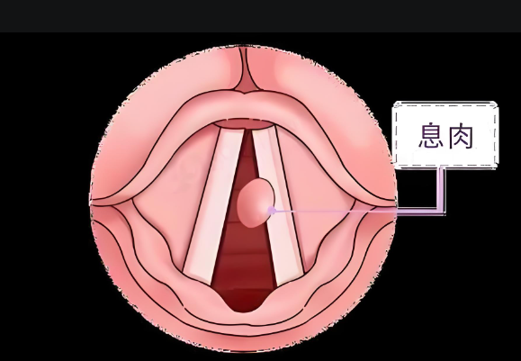 声音嘶哑、嗓子难受，声带息肉不可小觑(图1)