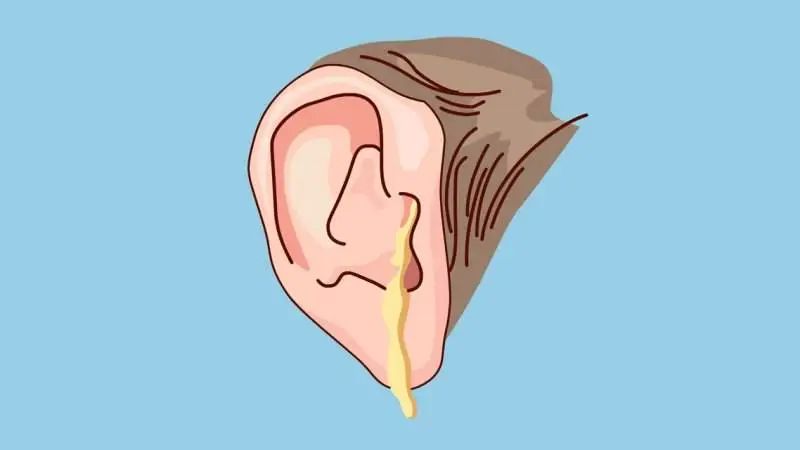 专家分享：中耳炎发作了怎么缓解疼痛？(图1)