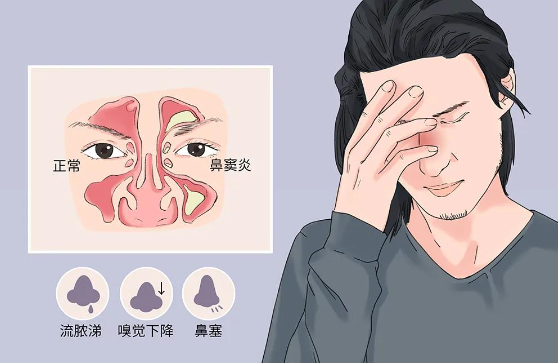 为什么感冒容易导致鼻窦炎，鼻窦炎该如何预防？(图1)