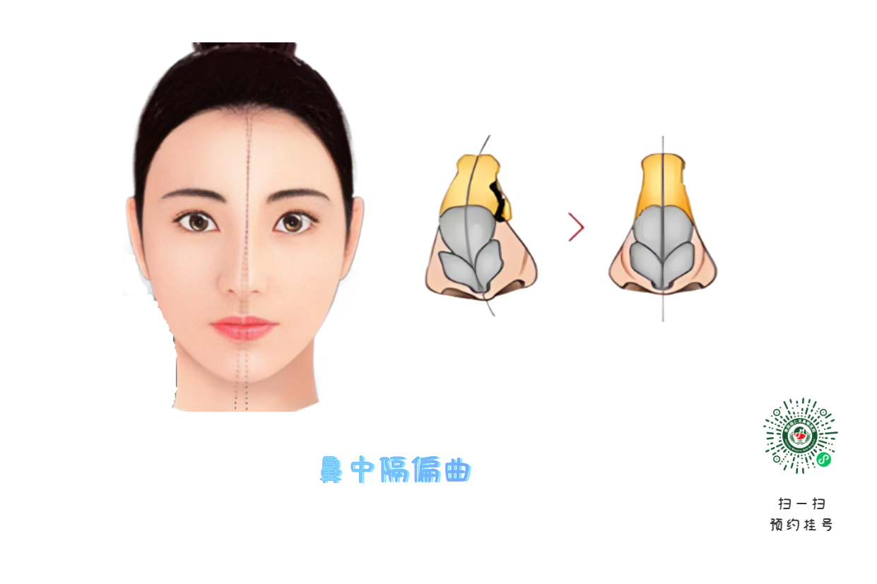 别把鼻塞当小事 它可能是鼻腔内的“隐形战争”(图1)