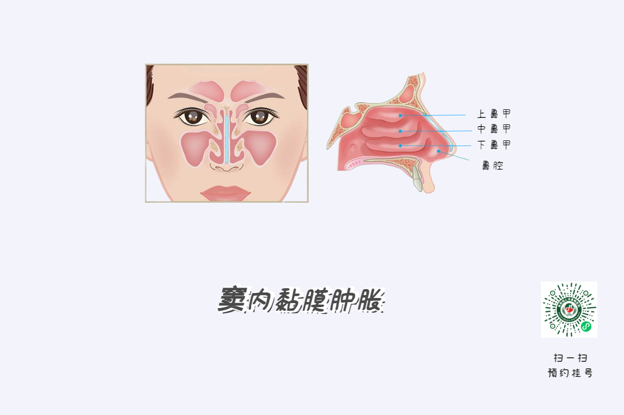 鼻窦炎头痛有特点！这个位置痛要当心(图4)