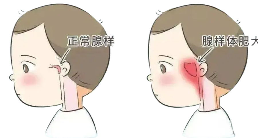 孩子腺样体肥大影响发育和容貌，趁五一假期，微创治疗快速治愈！(图1)