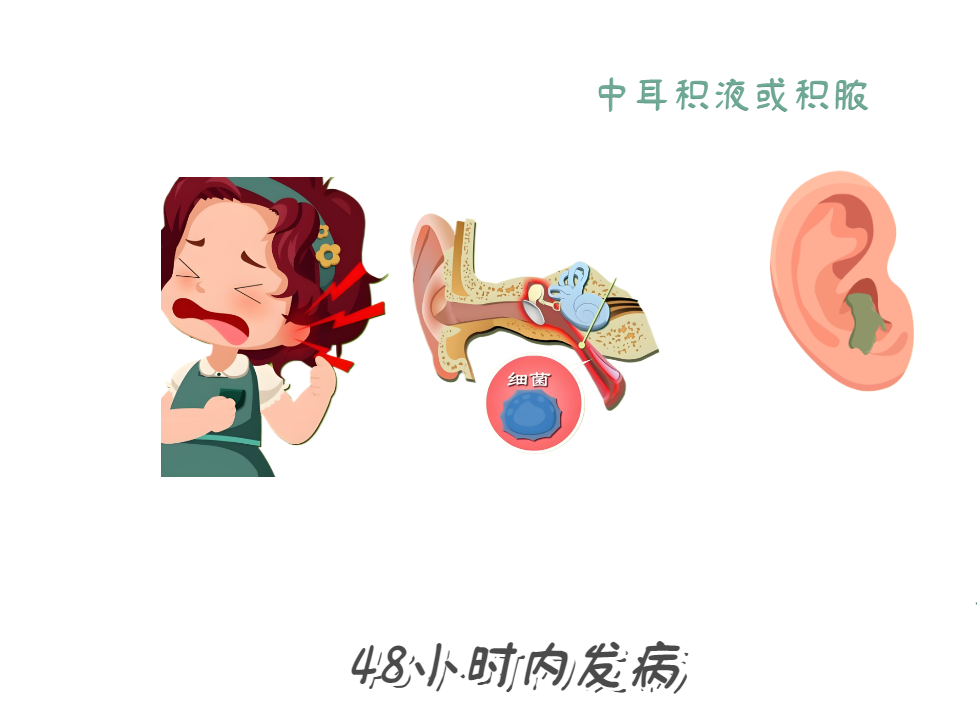 耳朵痛到睡不着？急性中耳炎急救法！(图2)