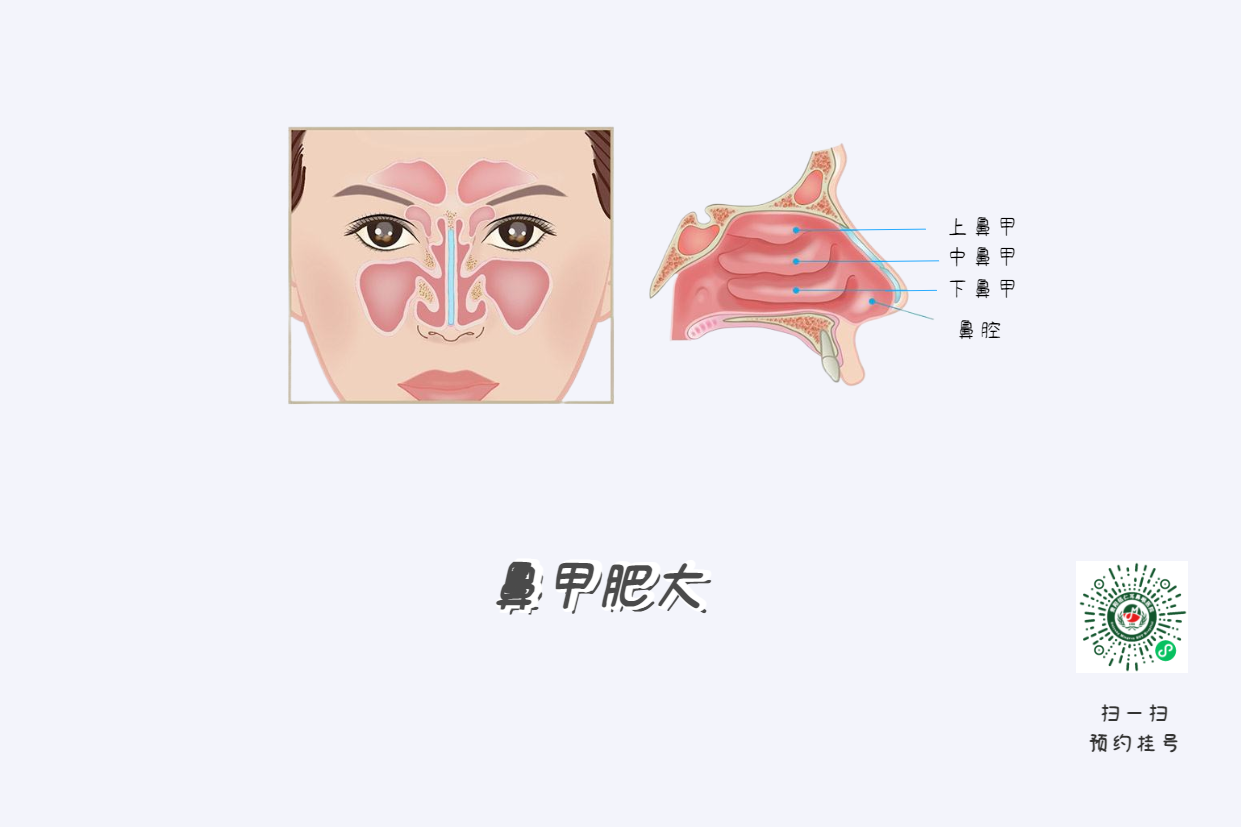 头痛欲裂？可能是鼻窦炎在作祟！(图2)